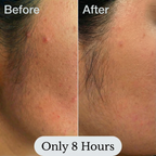 Hydrocolloid Pimple Patches <br> 360 Pack